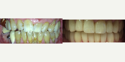 Dental Implants before and after photo