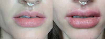 Dermal Fillers before and after photo