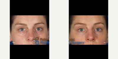 Eyelid Surgery before and after photo