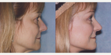 Facelift before and after photo