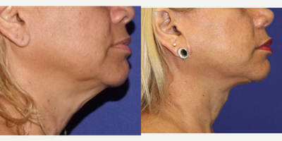 Neck Lift before and after photo