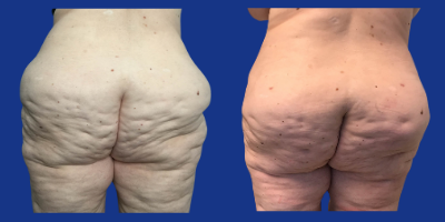 Brazilian Butt Lift before and after photo