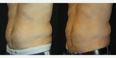 CoolSculpting before and after photo