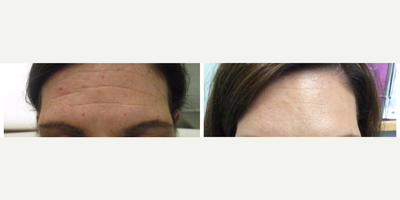 Botox before and after photo