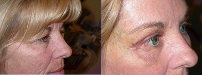 Brow Lift before and after photo