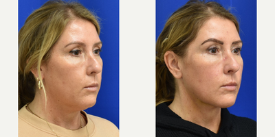 Chin Liposuction before and after photo