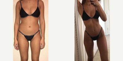 Liposculpture before and after photo