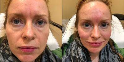 Nonsurgical Facelift before and after photo