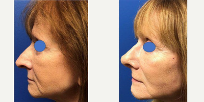 Rhinoplasty before and after photo