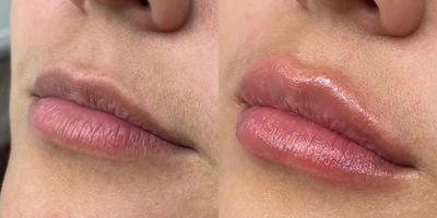 Dermal Fillers before and after photo
