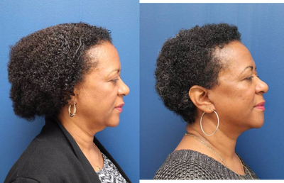 Facelift before and after photo