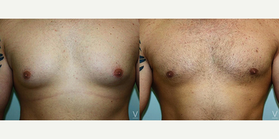 Gynecomastia Surgery before and after photo