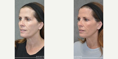 Lip Fillers before and after photo