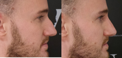 Nonsurgical Nose Job before and after photo