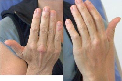 Radiesse before and after photo