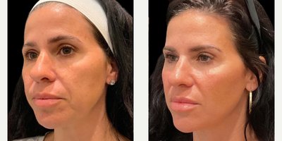 Botox before and after photo