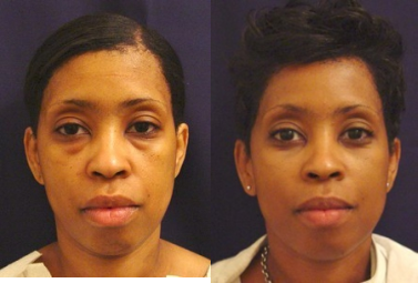 Eyelid Surgery before and after photo