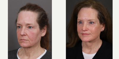 Eyelid Surgery before and after photo