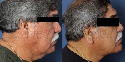 Facelift before and after photo