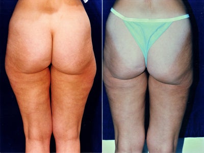 Liposuction before and after photo