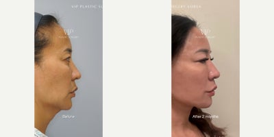 Neck Lift before and after photo