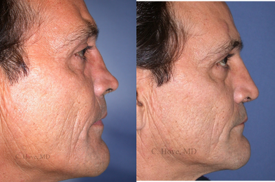 Revision Rhinoplasty before and after photo