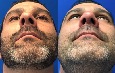 Rhinoplasty before and after photo