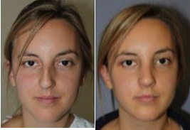 Septoplasty before and after photo