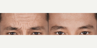 Botox before and after photo