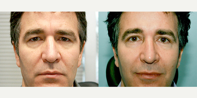 Eyelid Surgery before and after photo
