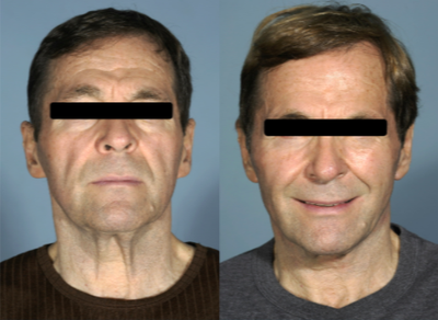 Facelift before and after photo