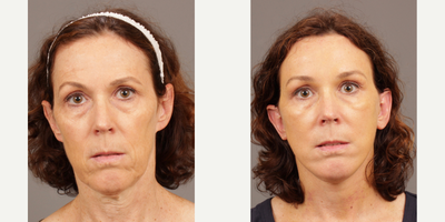 Facelift before and after photo