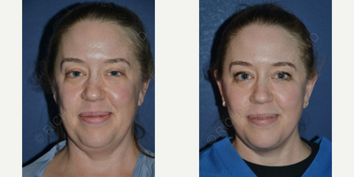 Facelift before and after photo