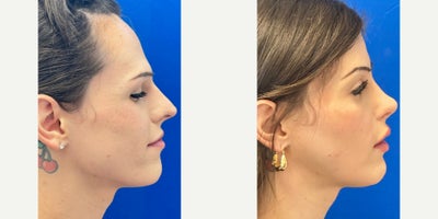 Facial Feminization Surgery before and after photo