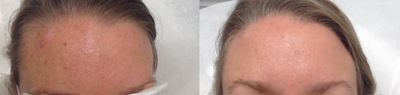IPL before and after photo
