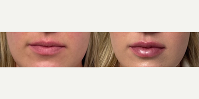 Lip Fillers before and after photo
