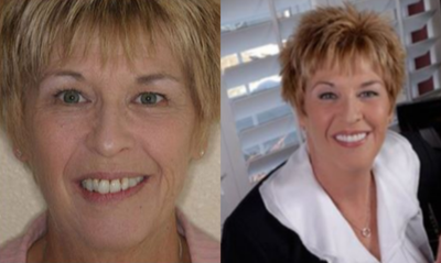 Porcelain Veneers before and after photo