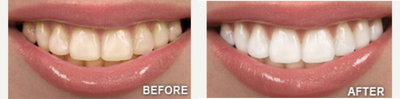 Zoom Whitening before and after photo