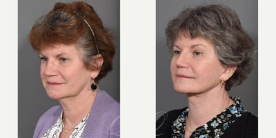 Brow Lift before and after photo