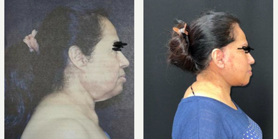 Facelift before and after photo