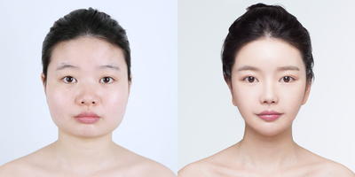 Jaw Reduction before and after photo