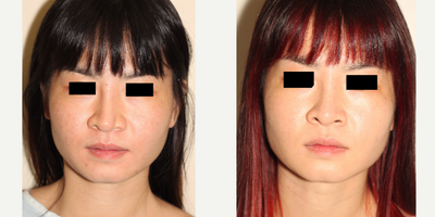 Revision Rhinoplasty before and after photo