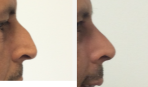 Rhinoplasty before and after photo