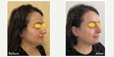 Rhinoplasty before and after photo