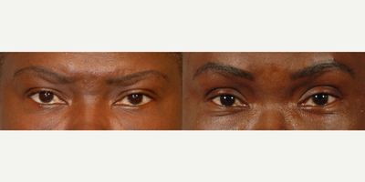 Botox before and after photo