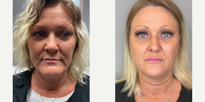 Dermal Fillers before and after photo