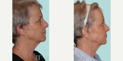 Dysport before and after photo