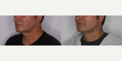 Facelift before and after photo