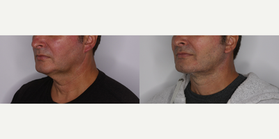 Facelift before and after photo