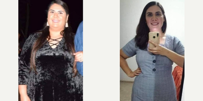 Gastric Sleeve Surgery before and after photo
